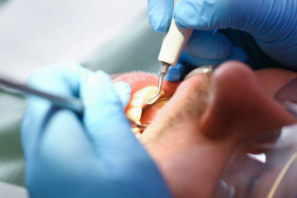 Best Emergency Tooth Extraction in Meadowlakes, TX