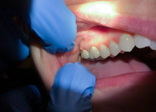 Best Emergency Dental Care for Broken or Chipped Teeth in Meadowlakes, TX